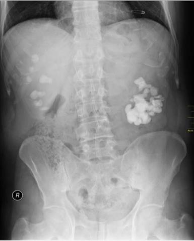 podem ser vistos na radiografia simples de