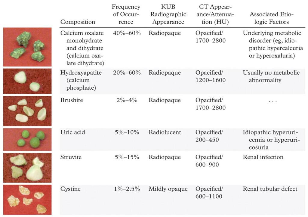 TRATO GENITOURINÁRIO: Urolitíase: Tomografia computadorizada Todos os cálculos, inclusive os de ácido úrico, aparecem densos na TC, existindo apenas 1 exceção, embora extremamente rara: cálculos