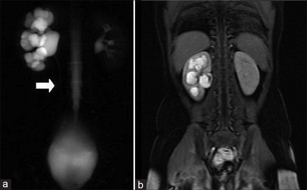 TRATO GENITOURINÁRIO: Urolitíase: Ressonância magnética Não é indicada para esse fim. Baixa sensibilidade para identificação de urolitíase.