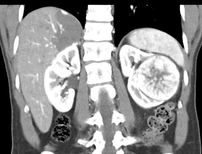 frequentes são primários do parênquima renal