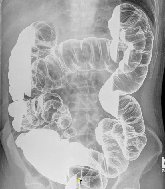 TRATO GASTRINTESTINAL: (ENEMA / CLISTER