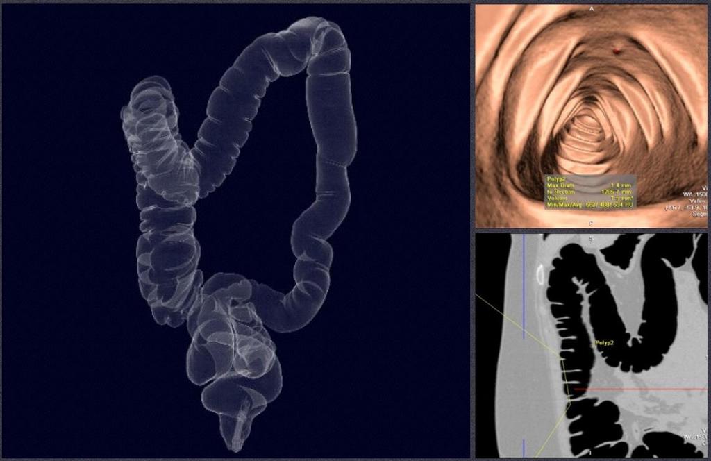 TRATO GASTRINTESTINAL: (COLONOGRAFIA POR TOMOGRAFIA) - Preparo: (semelhante ao clister / enema opaco) - Técnica: por