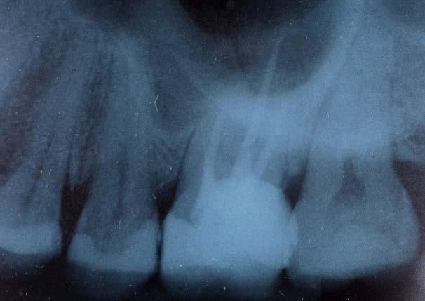 Na primeira consulta foi realizado exame clínico e radiográfico e constataram-se algumas restaurações antigas de resina composta fraturadas nos dentes posteriores (Figuras 1 e 2).