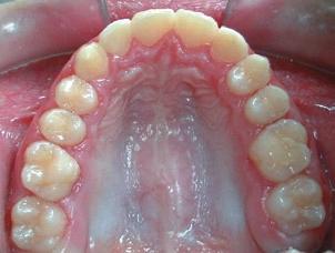 Na resolução das diferenças no tamanho e morfologia dos dentes, o canino superior esquerdo foi