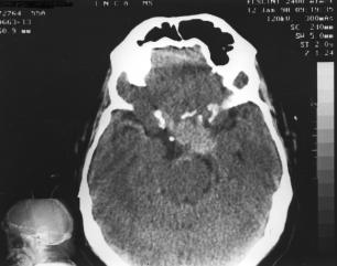 O paciente com estesioneuroblastoma não referiu sintomas oftálmicos, apesar da evidência de comprometimento orbitário secundário à TC.