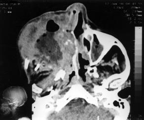 A fossa craniana anterior foi a região mais comumente lesada, acometida em oito casos (80%), seguida pela fossa craniana média em quatro casos (0%) e pelo lobo frontal (excluindo-se a fossa anterior)