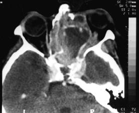 Comprometimento órbito-craniano por tumores malignos sinonasais: estudo por TC A B C D Figura. A: Plano axial pós-contraste ao nível das órbitas.
