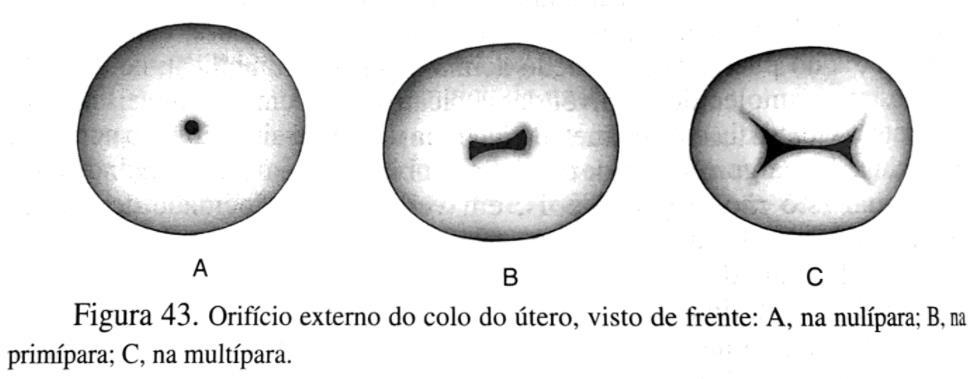 PERÍCIA DO PARTO NA MULHER VIVA Parto antigo Orifício do colo do