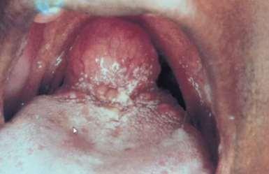 Imagem: esse é um exemplo de lesão tumoral de característica benigna (pois não existe ulceração da mucosa, ou vegetações).