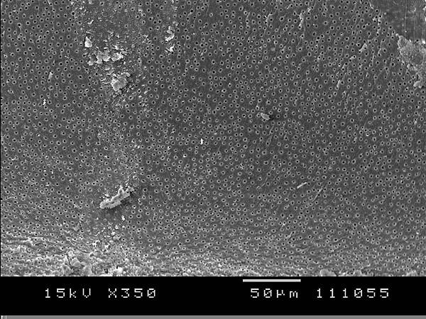 10Hz Figura 15 - Fotomicrografia eletrônica de varredura da porção apical do canal radicular após a