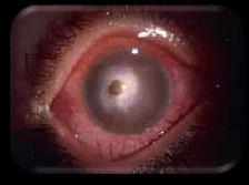 CONDIÇÕES QUE REDUZEM A ACUIDADE VISUAL: CERATITE (OU ÚLCERA DE CÓRNEA) É marcada pela perda de integridade da superfície corneana que se associa ao quadro do olho vermelho.