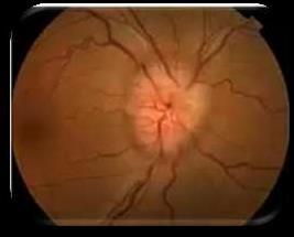 BAIXA DE VISÃO SÚBITA A baixa de visão súbita também é uma situação que pode ser enfrentada em um pronto-socorro de doenças oculares.
