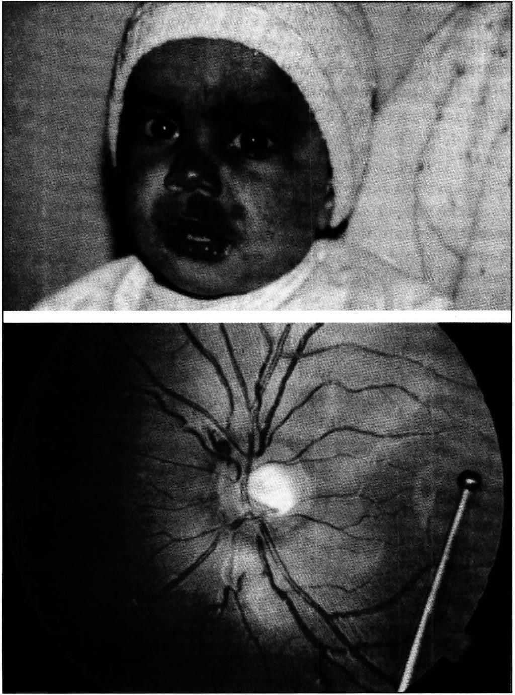 Ultra-som ocular na síndrome de Sturge- Weber O hemangioma difuso de coróide não é muito freqüente e a incidência exata deste tipo de hemangioma em pacientes com a síndrome de Sturge-Weber não está