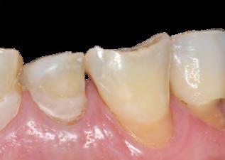 I NTRODUCAO ESTETICA, OCLUSAO E RESTAURACAO ALGUMAS DEFINIÇÕES DE OCLUSÃO, DESDE 1907 023 Relações normais dos planos inclinados oclusais dos dentes, quando as maxilas são fechadas.