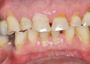 Por causa da natureza complexa da ATM e a musculatura facial, os dentes podem se encontrar numa variedade de posições oclusais 6.