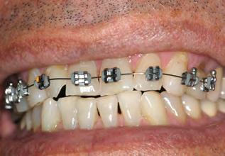 Atrição dentária nas superfícies incisais ou resinas