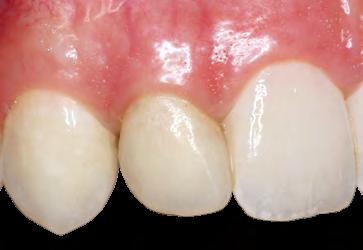 A B 07» A,B Para a restauração de um dente