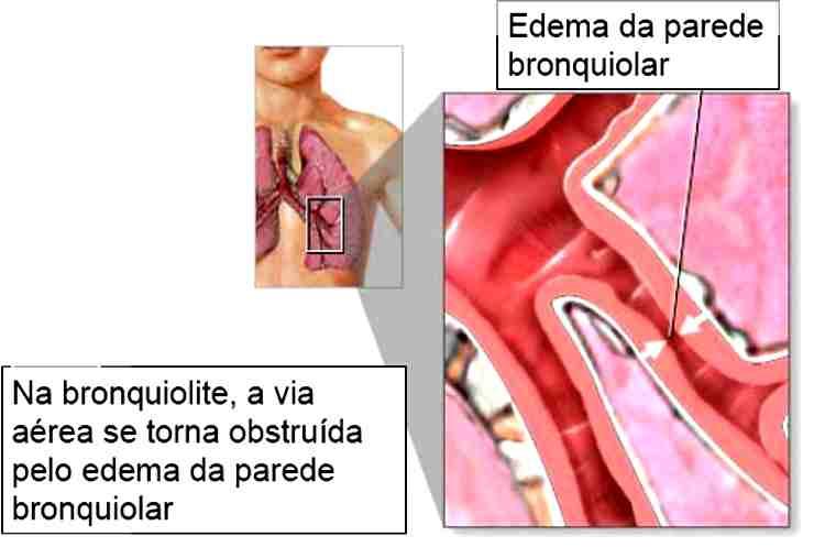 FISIOPATOLOGIA e muco.