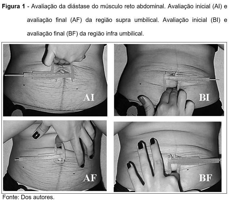 Por fim, na avaliação inicial da diástase do reto abdominal foi observado 3,7cm de diástase na região supra umbilical e 2,6cm de diástase para a região infra umbilical.