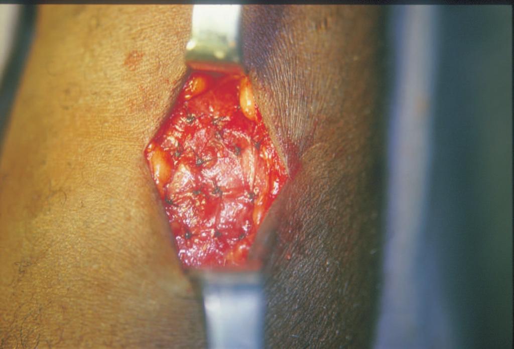 86 Resultados funcionais do auto-implante de paratireóides em loja única no tratamento do hiperparatireoidismo secundário O Serviço de Cirurgia de Cabeça e Pescoço do Hospital das Clínicas da