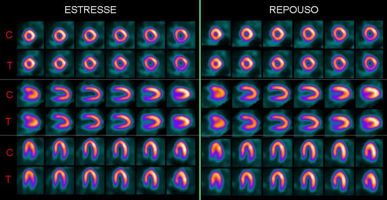 25 Figura 5. Exame normal. Na coluna da esquerda estão documentados os planos da reconstrução do estresse e na da direita os planos da reconstrução do repouso.