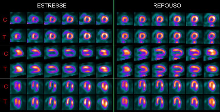 27 Figura 7. Exame anormal. Na coluna da esquerda estão documentados os planos da reconstrução de estresse e na da direita os planos da reconstrução do repouso.