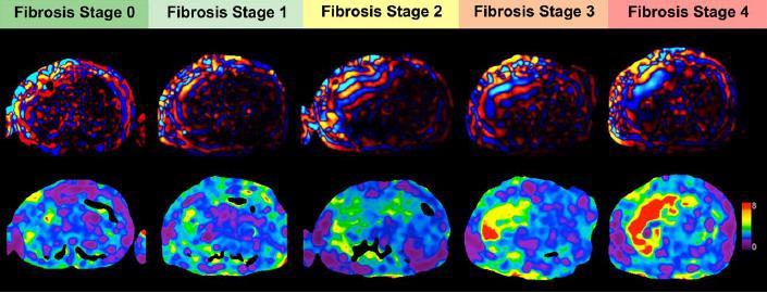 Interpretação Excelente correlação c/ grau histológico de fibrose