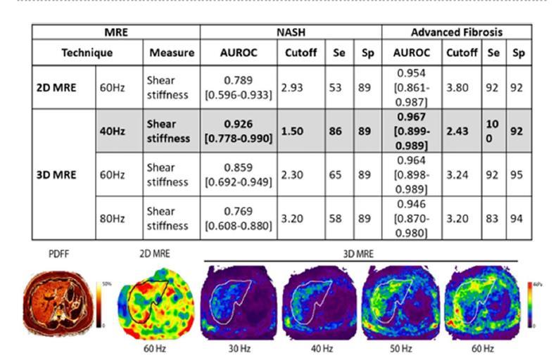 Elastografia 3D- Multifrequência Resultados preliminares promissores Viscosidade: ajudar a diferenciar aumento da rigidez