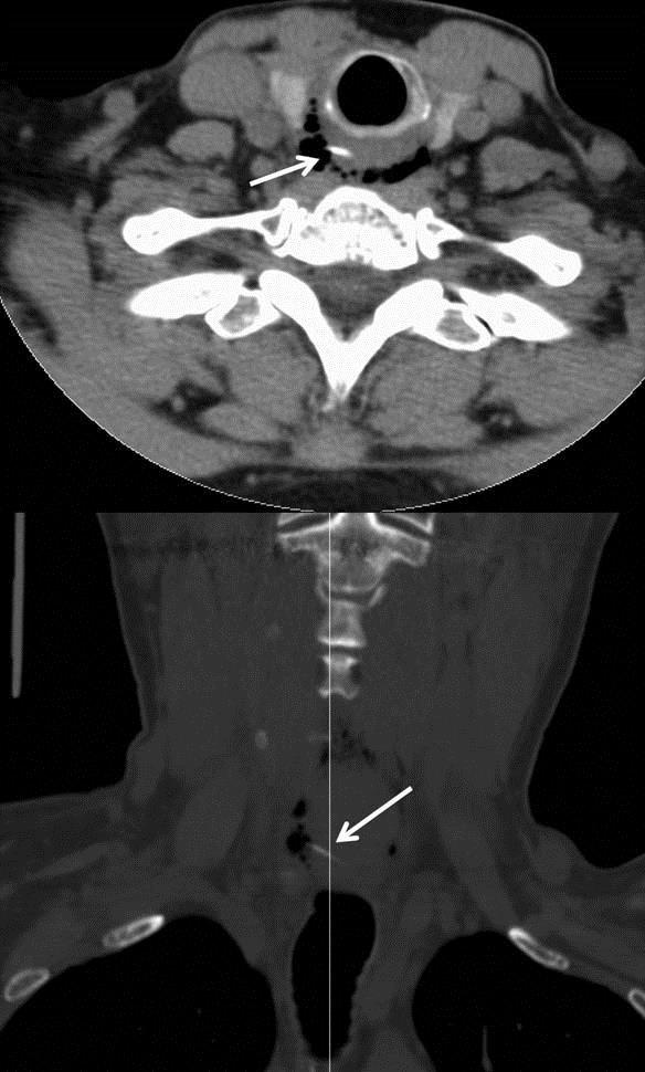 Fig.4: TC em corte coronal e axial mostrando uma espinha de peixe penetrando