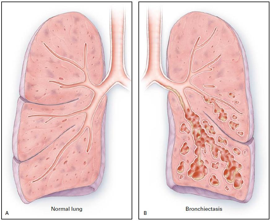 17 Figura 1 Bronquiectasias. A. Pulmão normal. B. Pulmão com bronquiectasias. Fonte: Reproduzido do N Engl J Med. 20