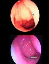 Nele, nota-se a presença de uma adenoide hipertrófica, em topografia de base de crânio, obstruindo a passagem de ar na porção posterior da fossa nasal: Imagem: o círculo vermelho marca os limites da