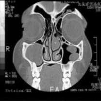 Essa variação pode ser causa importante de obstrução nasal.