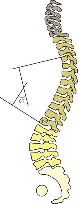 32 Cifose torácica A cifose torácica (CT) corresponde ao ângulo formado entre o ponto de inflexão da coluna lombar (geralmente T12-L1) até o final da curvatura próximo ao corpo central de C7 e o