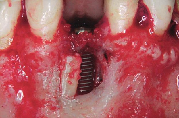 apicectomia neste dente. Fig.