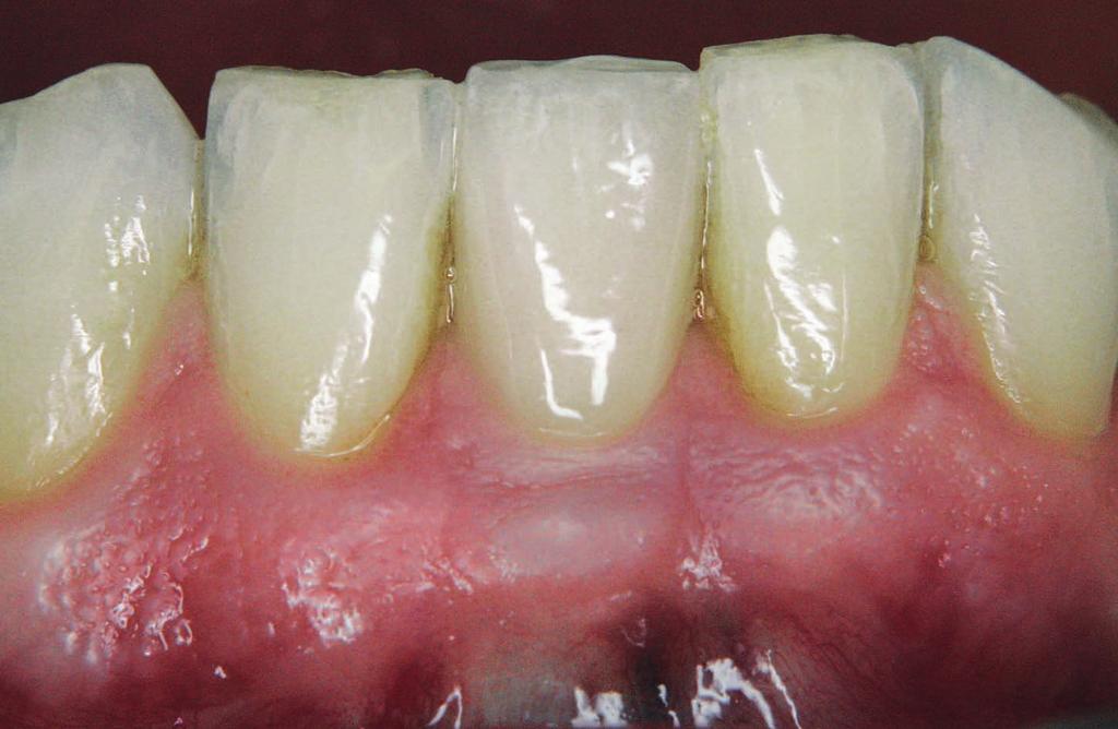 Clin. Oral Impl. Res. 2001; 12:632 639. 2 Cardaropoli G, Hayacibara R, sukekava F, Araujo M, Lindhe J.