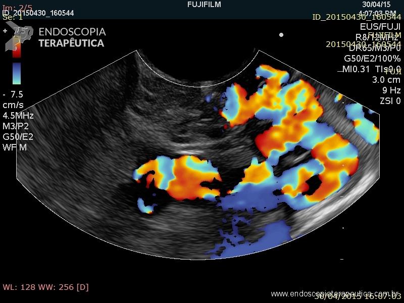 Figura 2: Varizes de fundo gástrico a ecoendoscopia com doppler UNIFESP 2015 Além de melhor avaliação das varizes esofago-gástricas, o EUS surge com uma proposta de melhorar a terapêutica destas