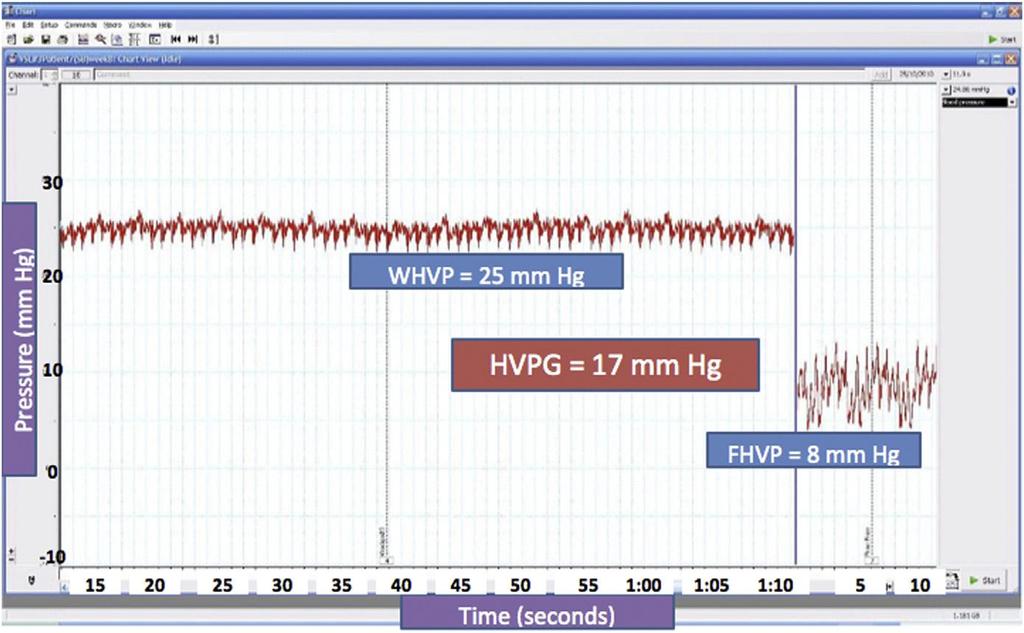 Hipertensão Portal Traçado típico do GPVH Equilibration of WHVP requires more