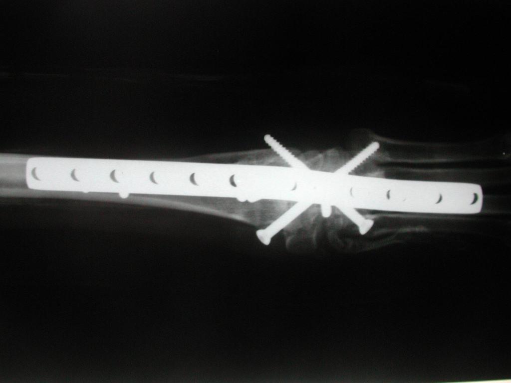 Nota-se a presença de dois parafusos cruzados de 4,5 mm de diâmetro, produzindo maior estabilidade do implante.