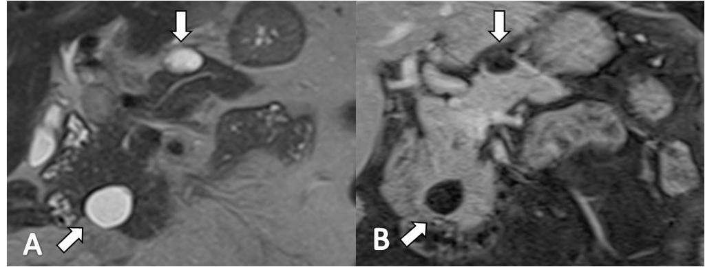 Figura 1. Ressonância magnética ponderada em T2 (A) e T1 com contraste (B) no plano axial mostrando pequenas lesões císticas em contato com ducto pancreático (setas).