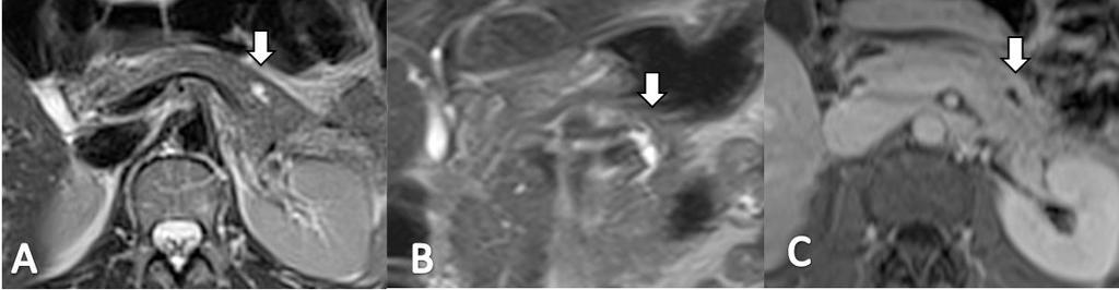 Ressonância magnética ponderada em T2 axial (A), T2 coronal (B) e T1 axial com contraste mostrando pequena lesão cística na cauda do pâncreas, com dilatação segmentar do ducto pancreático (setas).