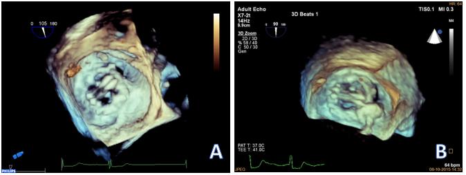 Figura 5 - Caso clínico ilustrativo 2 Uma doente de 54 anos, com antecedentes de três cirurgias cardíacas, a última foi uma substituição valvular mitral por prótese mecânica de duplo disco (cirurgia