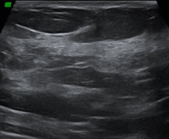 fibroglandular c.