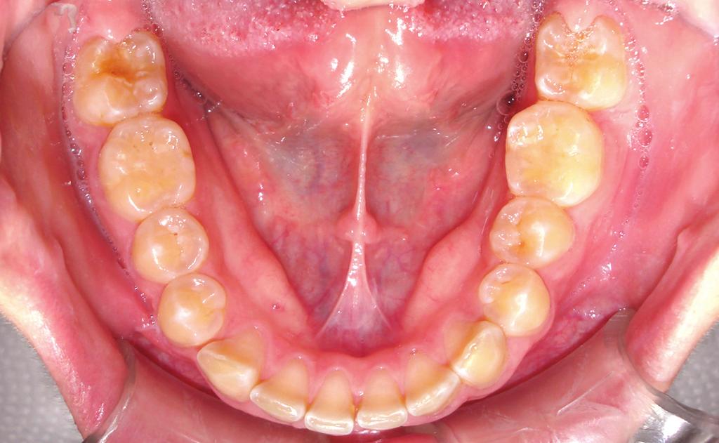 (In-Ovation-L, Dentsply-GAC).