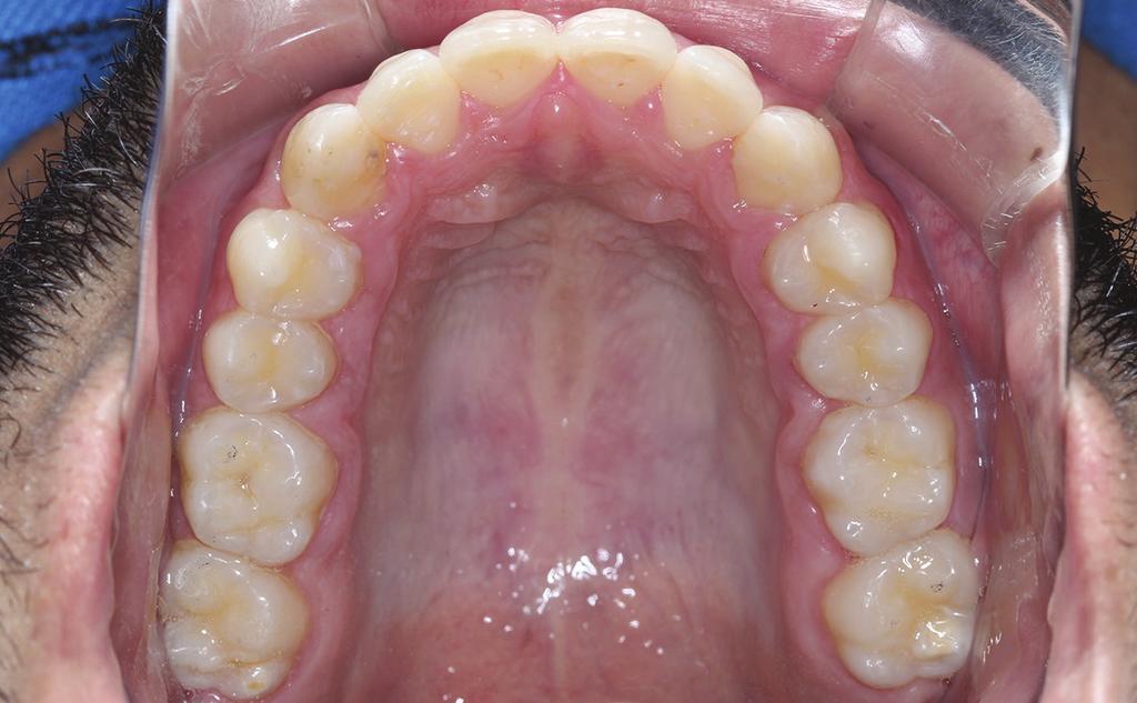 Nos dois pacientes foi utilizado o Bacci Bonding System (BBS) para o posicionamento de bráquetes linguais de base anatômica (In-Ovation L, Dentsply-GAC).