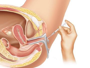 Ultrassonografia na Infertilidade Inseminação Intrauterina introdução de sêmen preparado no laboratório na cavidade uterina ciclo natural ou uso de