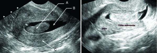 Ultrassonografia na Infertilidade Histerossonografia sonda no útero por via vaginal
