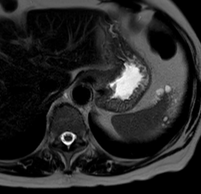 LINFANGIOMA É a segunda neoplasia benigna mais comum Pequenos canais linfáticos dilatados Mais frequente