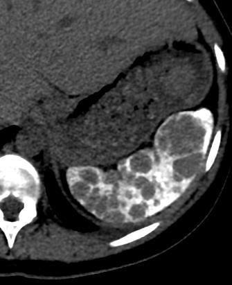 Autoesplenectomia - Pequeno, denso