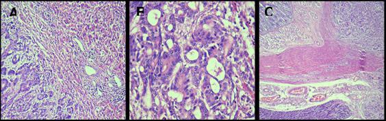 Colangiocarcinoma em felino com vírus da leucemia 5 Já o exame histológico revelou tratar-se de um colangiocarcinoma com metástases para baço, duodeno e pâncreas como ilustra a figura 5.