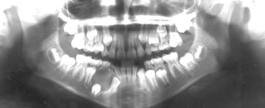 Dentígero) Figura 4.